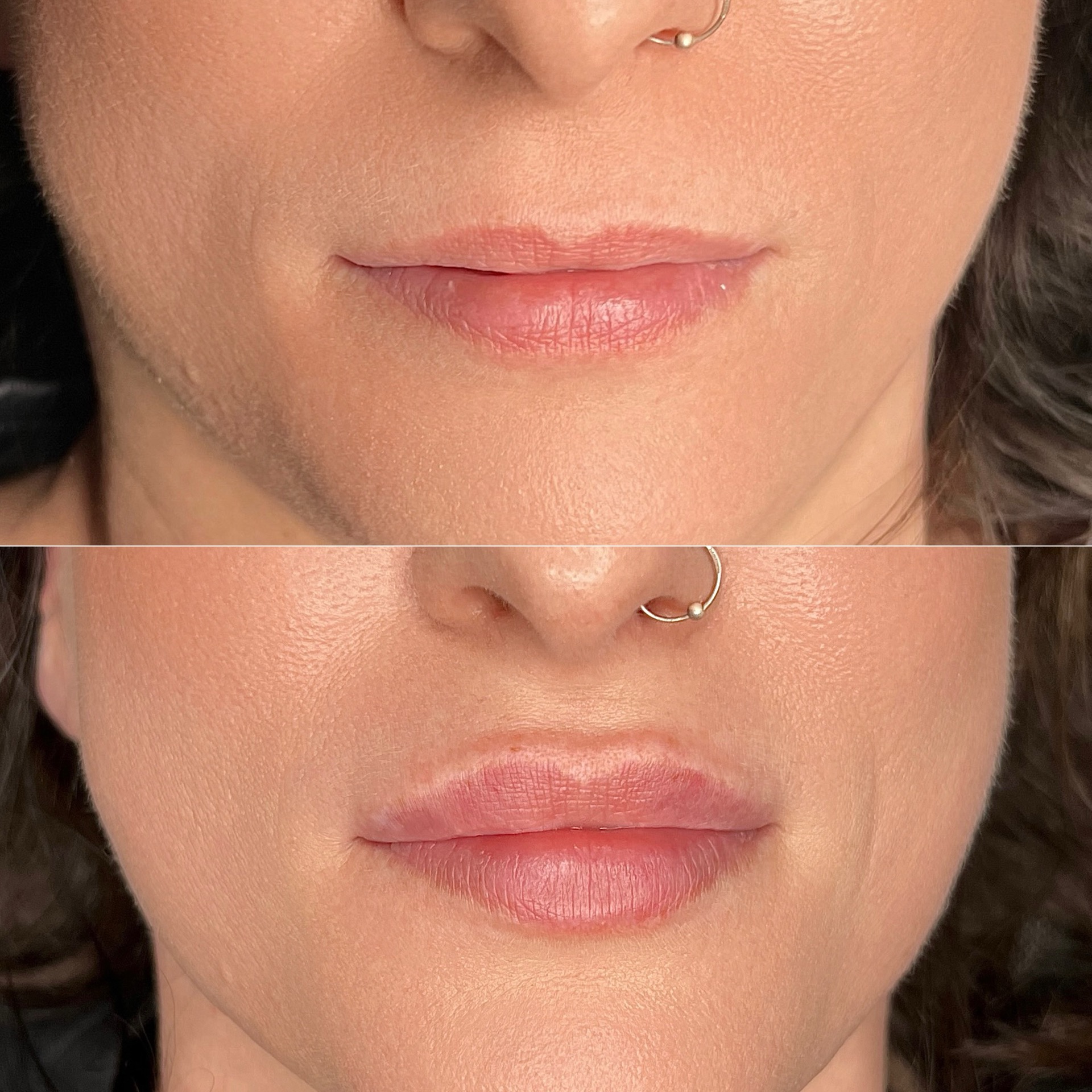 Powiększanie i modelowanie ust